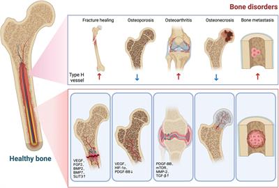 Type H vessels: functions in bone development and diseases